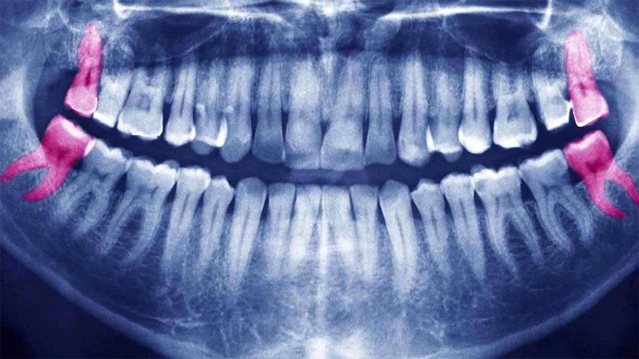 Качественное удаление зуба мудрости в Тюмени без боли