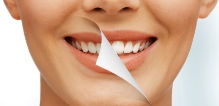 Отбеливание зубов Дентал-люкс