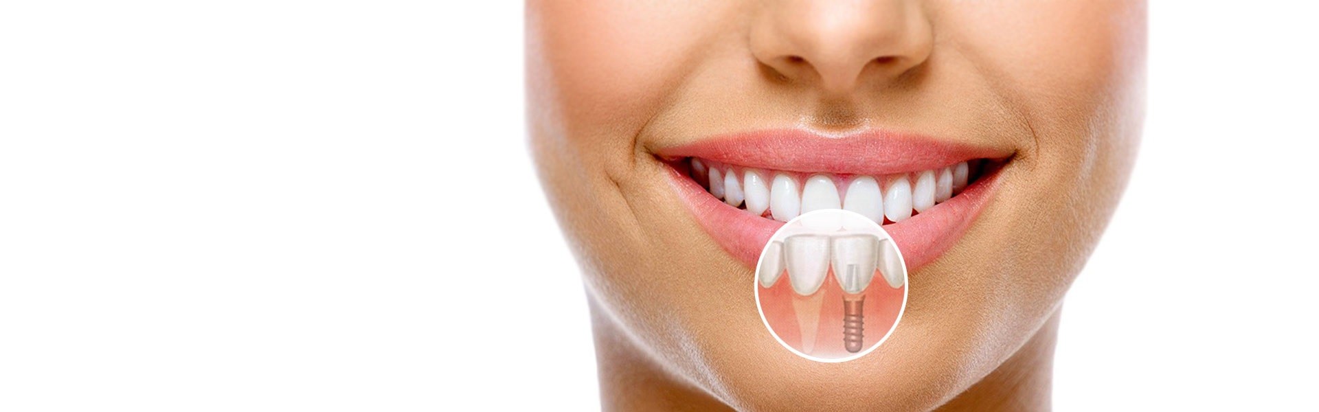 Высокопрофессиональная имплантация зубов под ключ в современной стоматологической клинике.