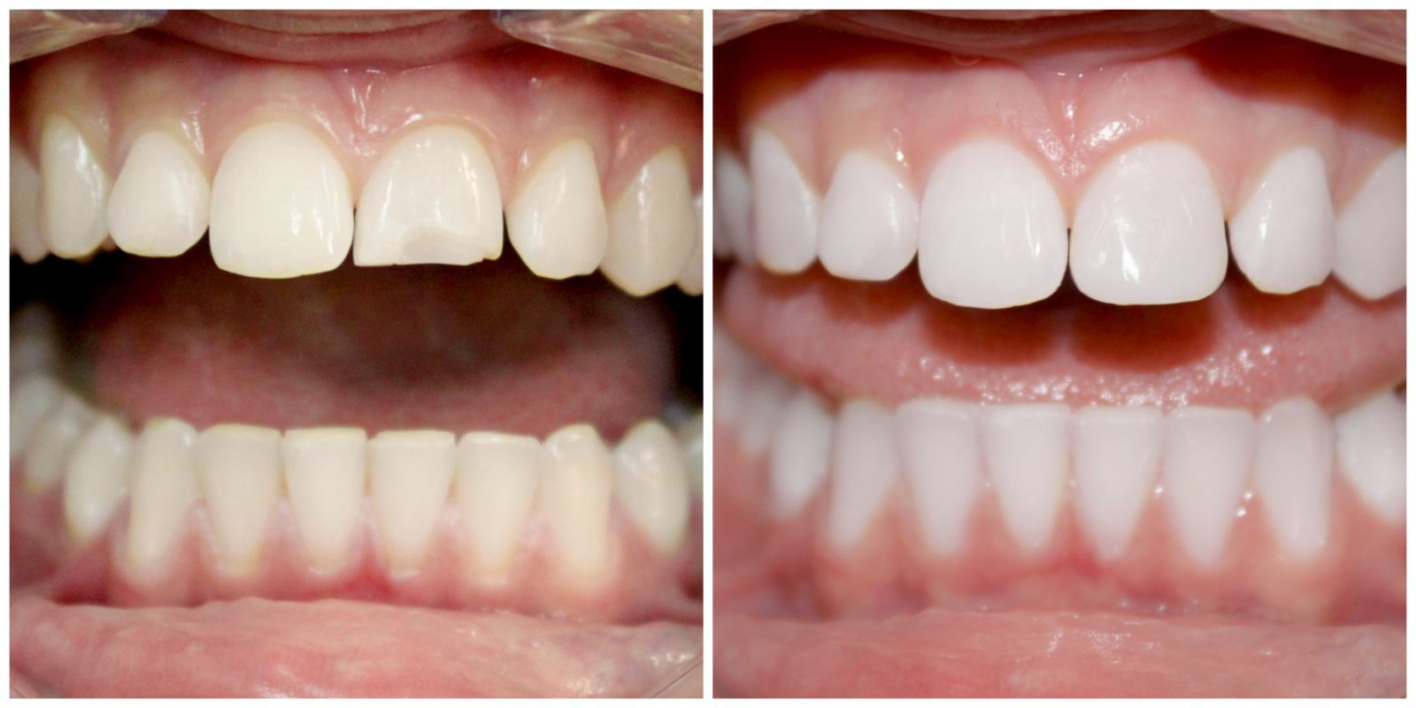 Профессиональная гигиена полости рта и удаление зубного камня в Тюмени.
