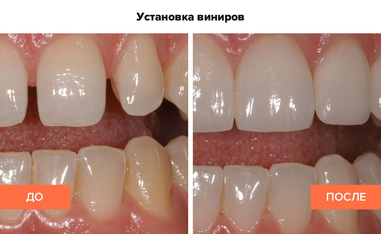 Квалифицированная установка виниров на зубы с гарантией в клинике «Дентал Люкс».