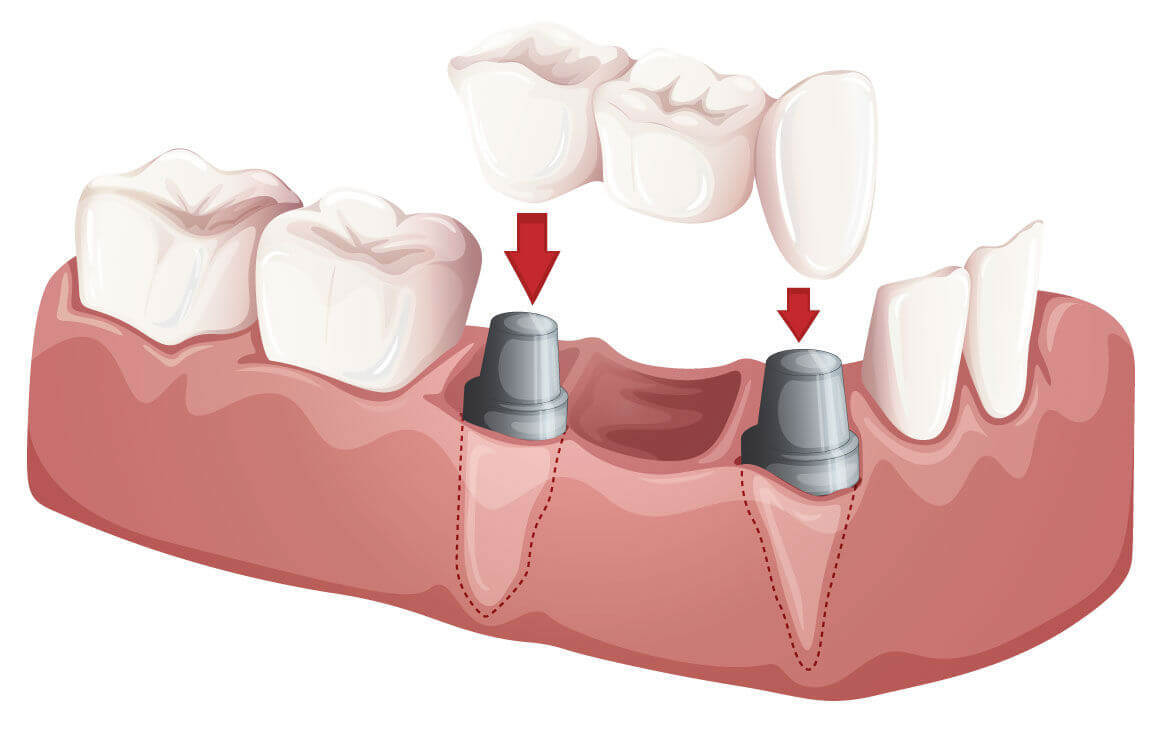 Одноэтапная имплантация зубов в Тюмени без разрезов и швов по доступной цене.