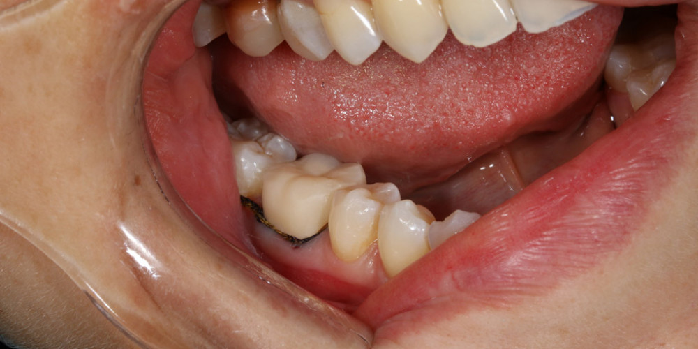 Высококачественное пломбирование зубов в Тюмени с гарантией