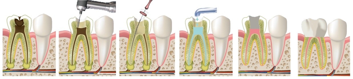 Лечение острого и хронического пульпита в стоматологии
