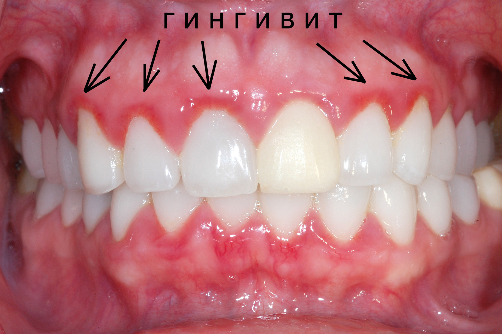 Предлагаем услугу лечения гингивита в Тюмени квалифицированными стоматологами.