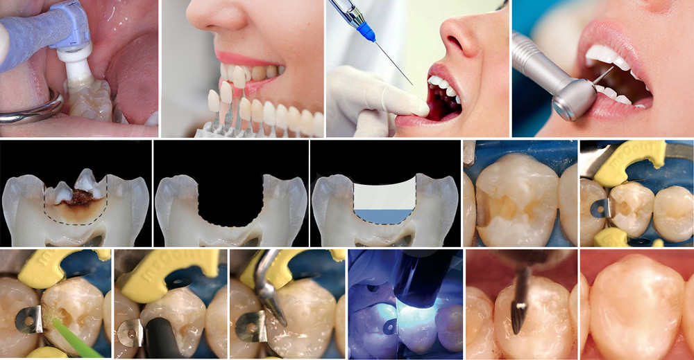 Лечение кариеса в Тюмени в стоматологии европейского уровня