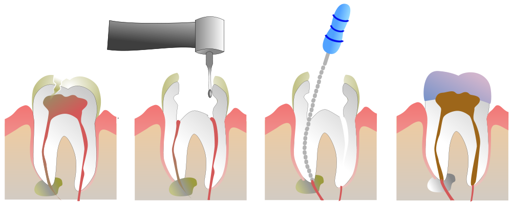 Лечение каналов зуба в Тюмени