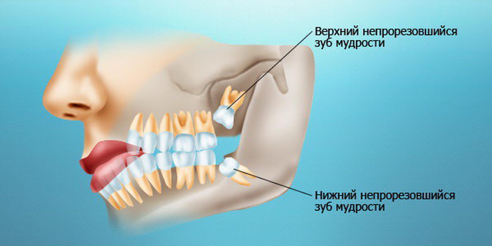 Безболезненное удаление зуба мудрости в Тюмени профессиональными стоматологами.