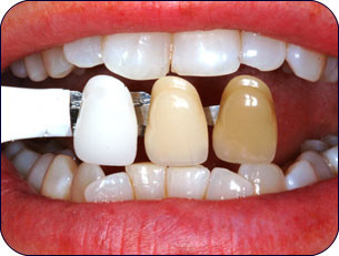 Отбеливание зубов в Тюмени  