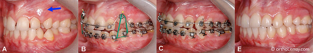 В случае если требуется установить брекеты в Тюмени, вы можете обратиться за квалифицированной помощью в стоматологию «Дентал-Люкс». Мы окажем вам необходимую помощь на высшем уровне