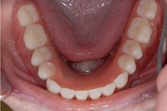 Имплантология зубов — это достаточно инновационное явление в сфере стоматологии, которое активно и весьма успешно используется в клинике «Дентал Люкс» на протяжение нескольких лет.