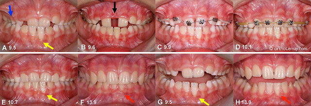 В случае если требуется установить брекеты в Тюмени, вы можете обратиться за квалифицированной помощью в стоматологию «Дентал-Люкс»