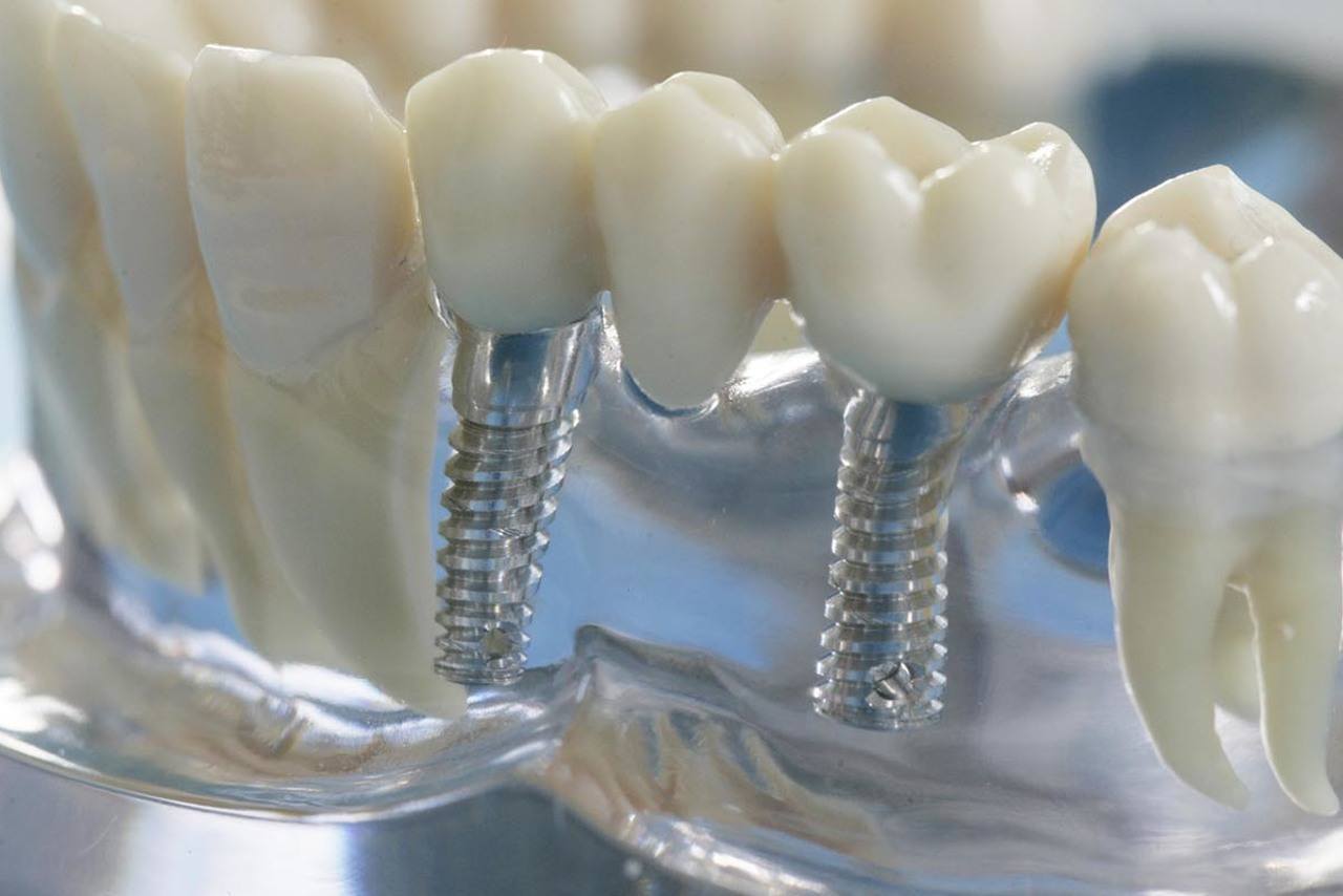 Качественная имплантация зубов в Тюмени. Импланты от признанных мировых лидеров.