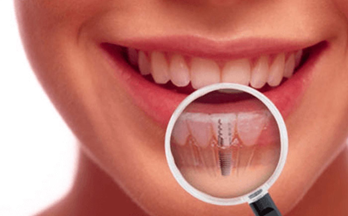 Квалифицированное восстановление передних зубов, установка имплантов по доступной цене.