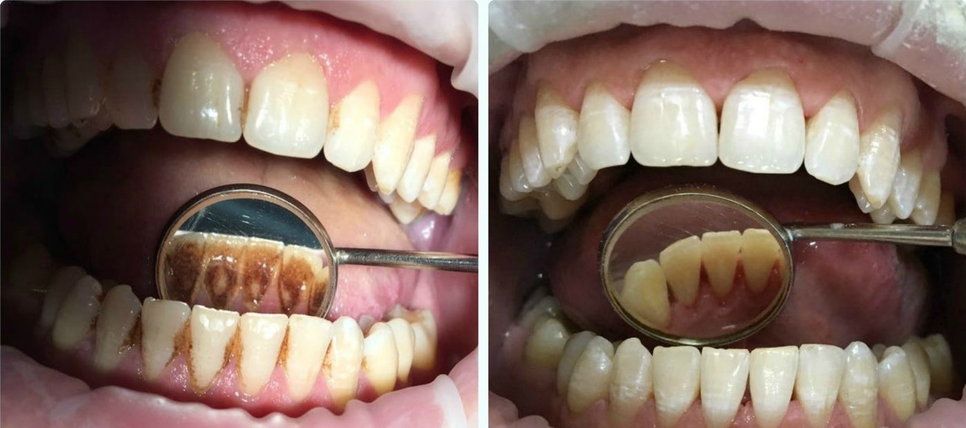 Профессиональная гигиена полости рта и удаление зубного камня в Тюмени