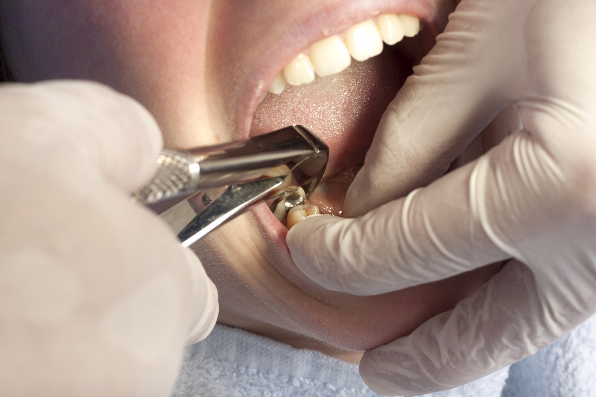 Оперативное безболезненное удаление зубов в Тюмени по доступной цене в клинике Дентал Люкс.