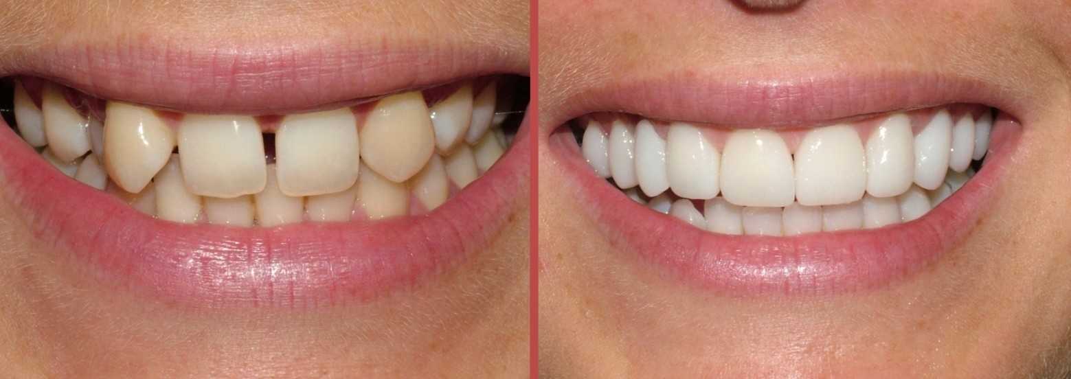 Реставрация фронтальных, кривых зубов с применением фотополимера и виниров.