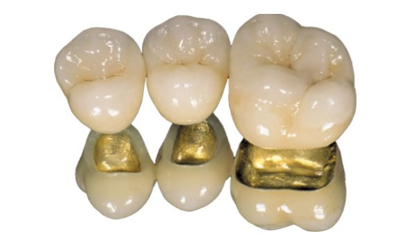 Установка качественных металлокерамических протезов в профессиональной стоматологии.